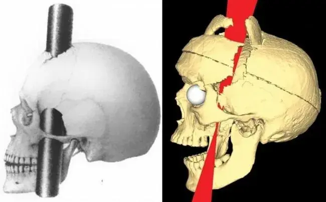 Człowiek z dziurą w głowie: Szokujący przypadek Phineasa Gage'a